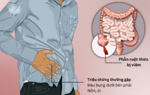 Triệu chứng của bệnh đau ruột thừa