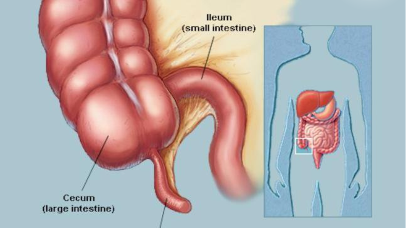 triệu chứng đau ruột thừa