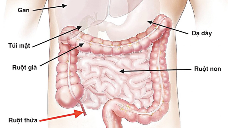 vị trí đau ruột thừa