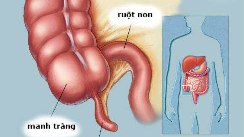 triệu chứng đau ruột thừa bên trái hay phải