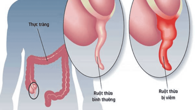 cách nhận biết đau ruột thừa ở người lớn