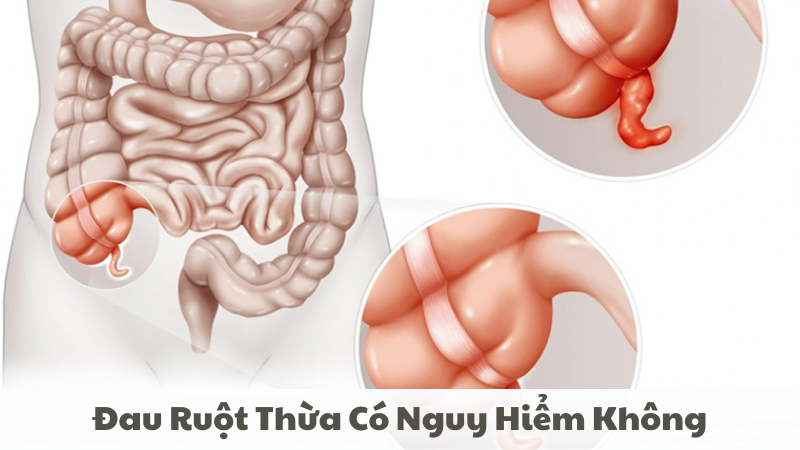 đau ruột thừa có nguy hiểm không