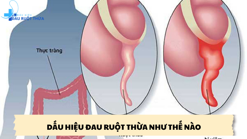 dấu hiệu đau ruột thừa như thế nào