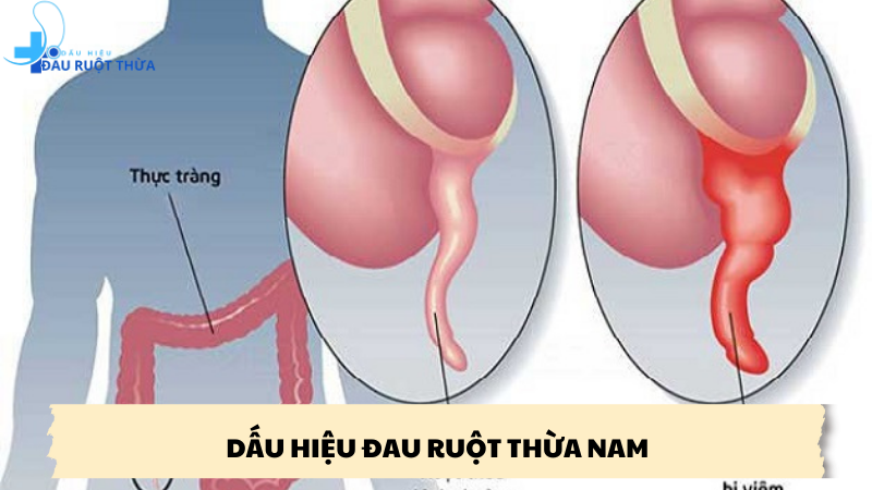 dấu hiệu đau ruột thừa nam